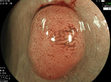内視鏡的粘膜切除術（EMR)